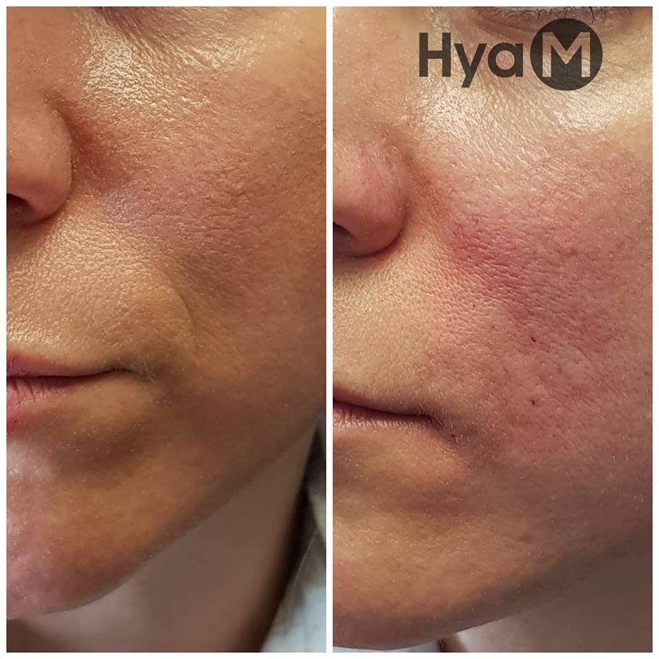 Formation au soin hyaluronique : rides d'amertume