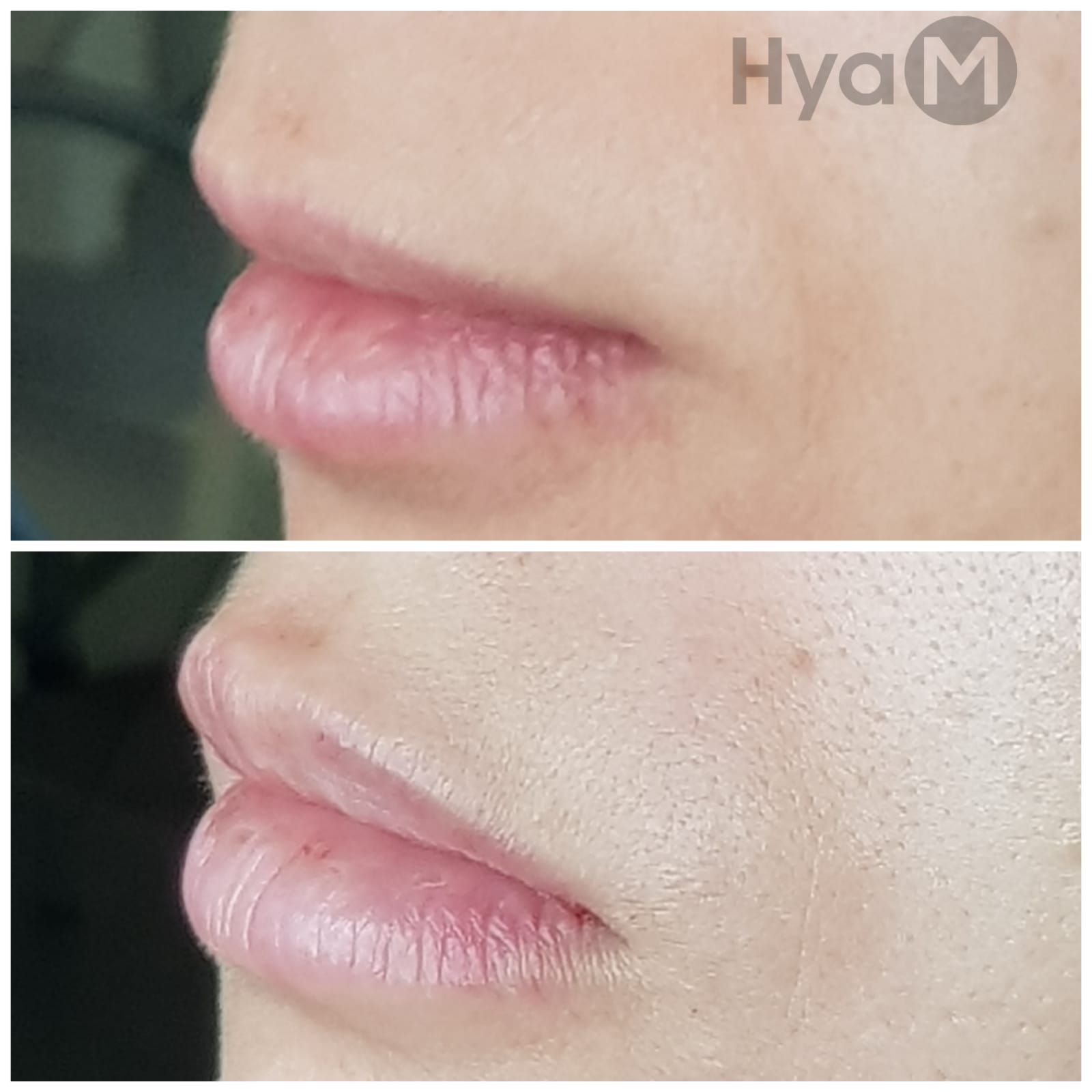 Formation au soin hyaluronique : rides du fumeur