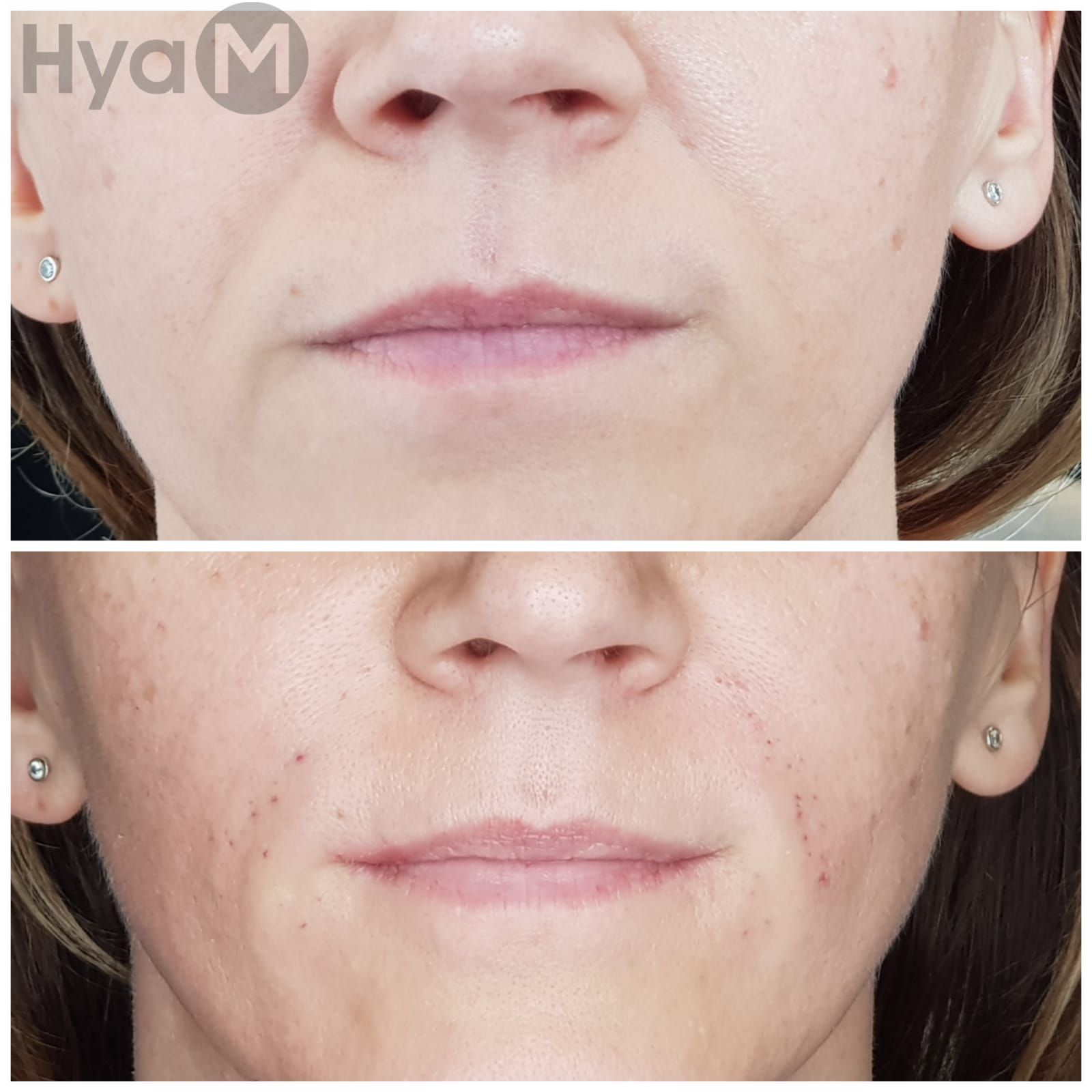 Formation au soin hyaluronique : sillons nasogéniens